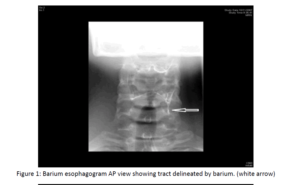 otolaryngology-online-journal-delineated-barium