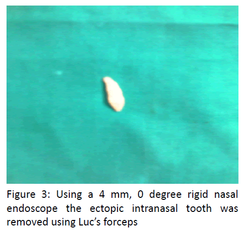 otolaryngology-online-journal-ectopic-intranasal