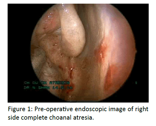 otolaryngology-online-journal-endoscopic-image