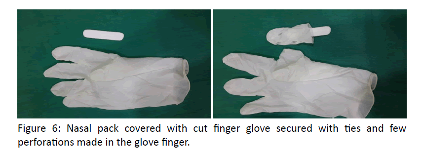 otolaryngology-online-journal-finger-glove