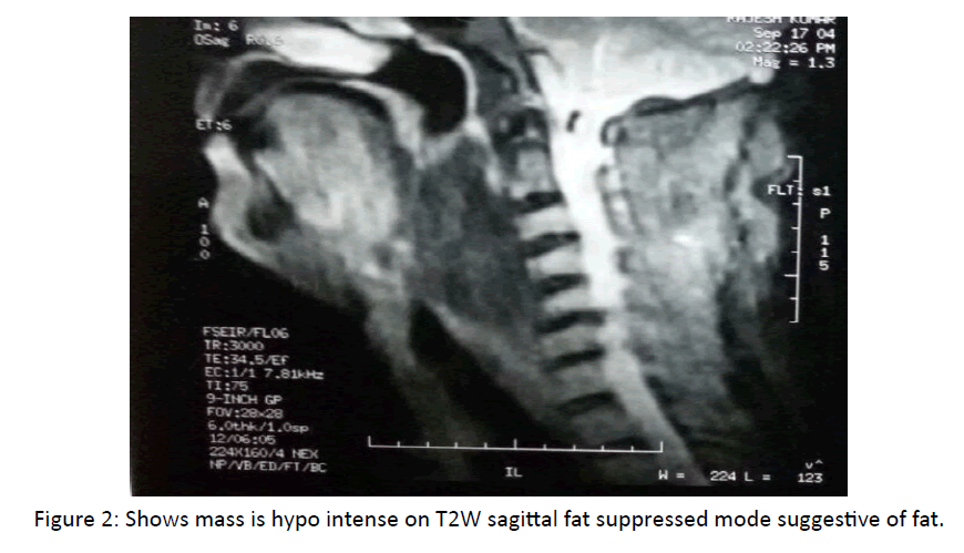 otolaryngology-online-journal-hypo-intense