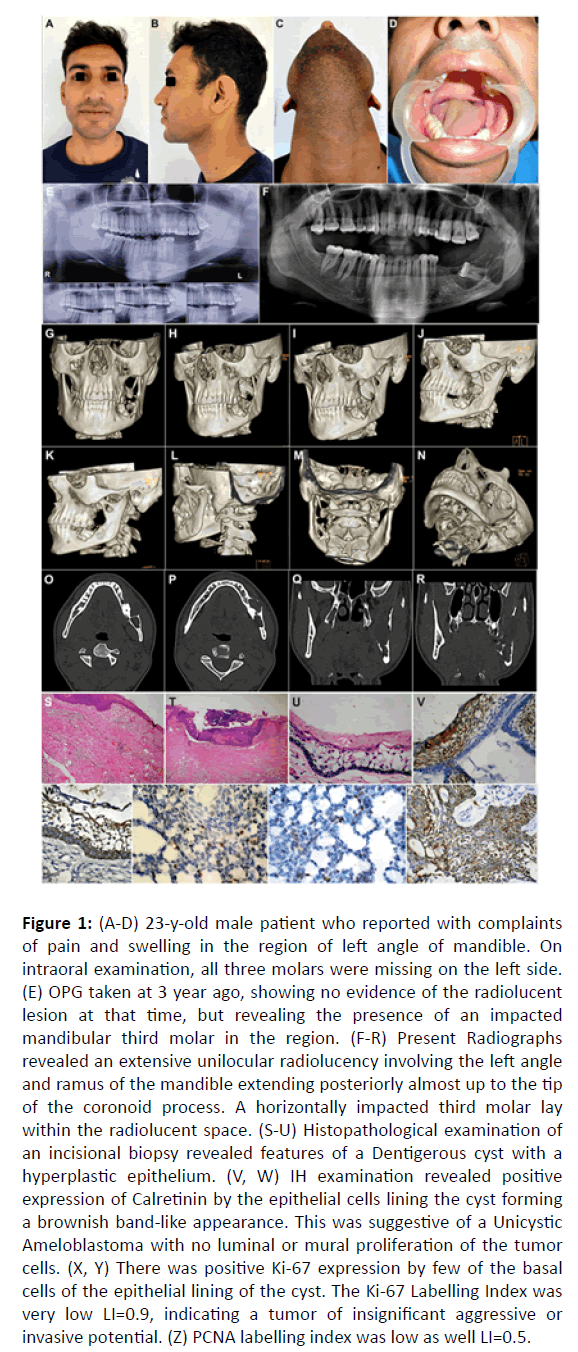 otolaryngology-online-journal-intraoral-examination