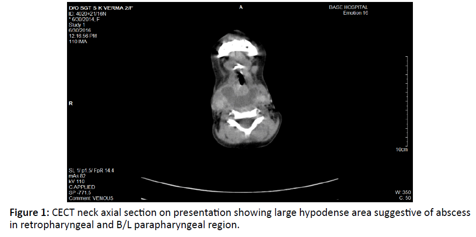 otolaryngology-online-journal-large-hypodense