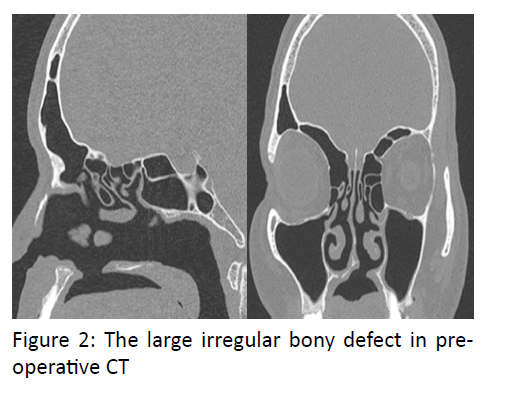 otolaryngology-online-journal-large-irregular-bony