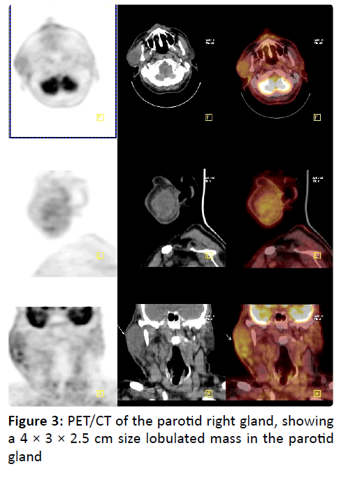 otolaryngology-online-journal-lobulated-mass-parotid