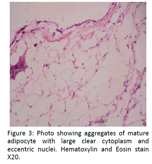 otolaryngology-online-journal-mature-adipocyte
