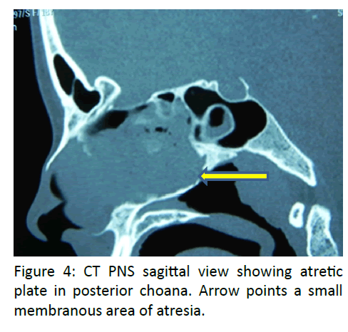 otolaryngology-online-journal-membranous-area