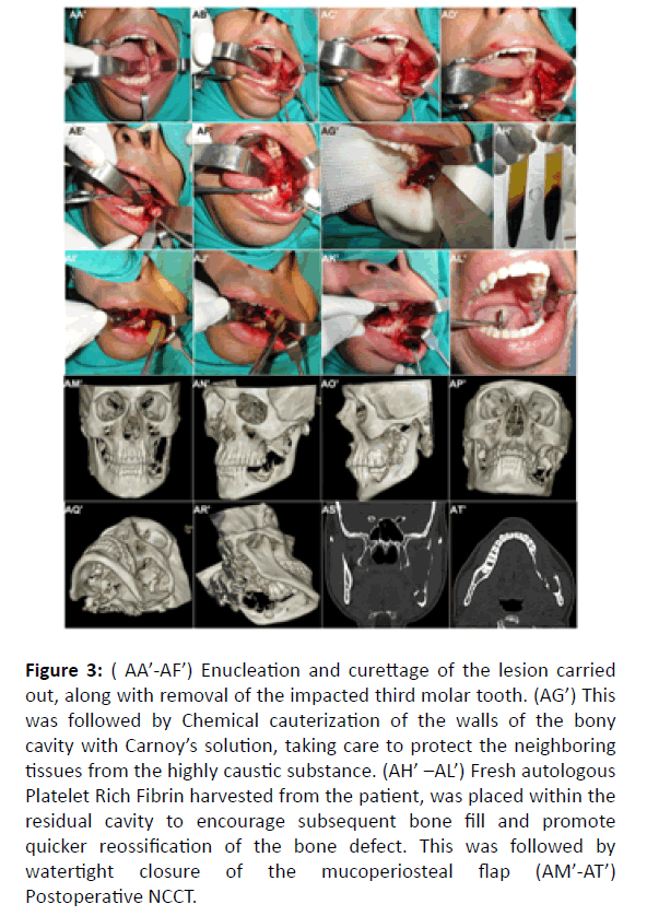 otolaryngology-online-journal-molar-tooth
