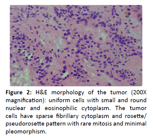 otolaryngology-online-journal-morphology-tumor