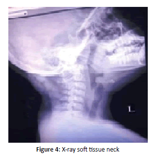 otolaryngology-online-journal-neck