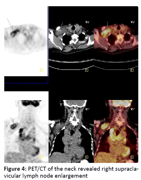 otolaryngology-online-journal-neck-revealed-right-supraclavicular