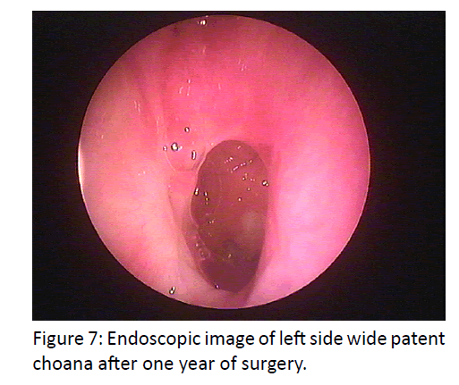 otolaryngology-online-journal-patent-choana