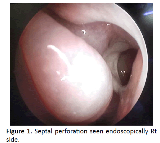 otolaryngology-online-journal-perforation