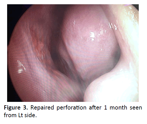 otolaryngology-online-journal-perforation