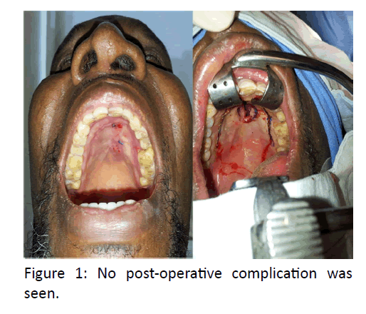 otolaryngology-online-journal-post-operative-complication