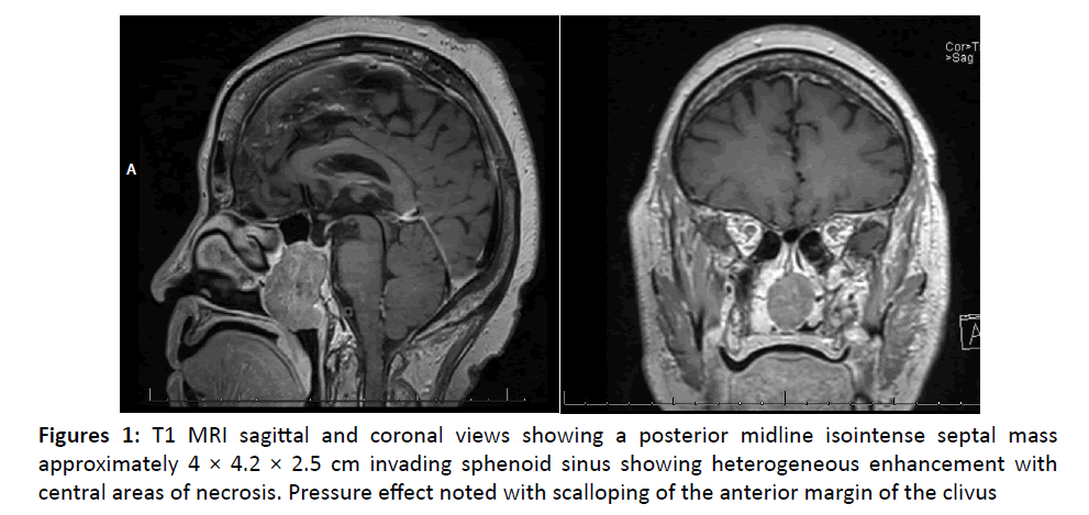 otolaryngology-online-journal-posterior-midline-isointense