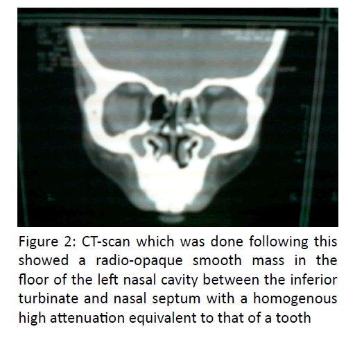 otolaryngology-online-journal-radio-opaque