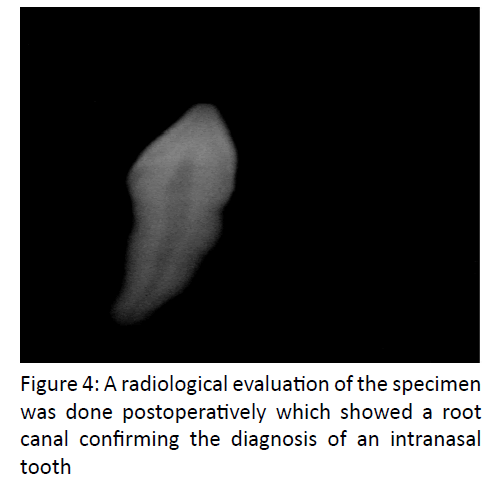 otolaryngology-online-journal-radiological-evaluation