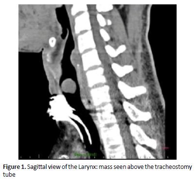 otolaryngology-online-journal-tracheostomy