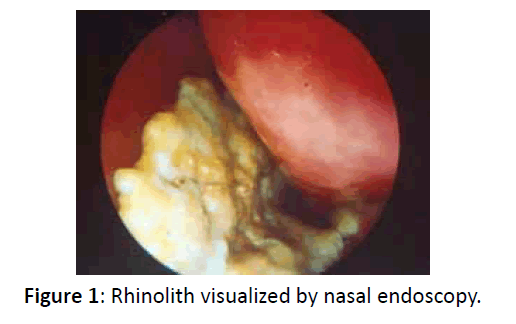 otolaryngology-online-journal-visualized-nasal-endoscopy