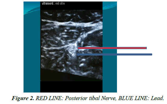 pain-management-therapy-Posterior-tibal