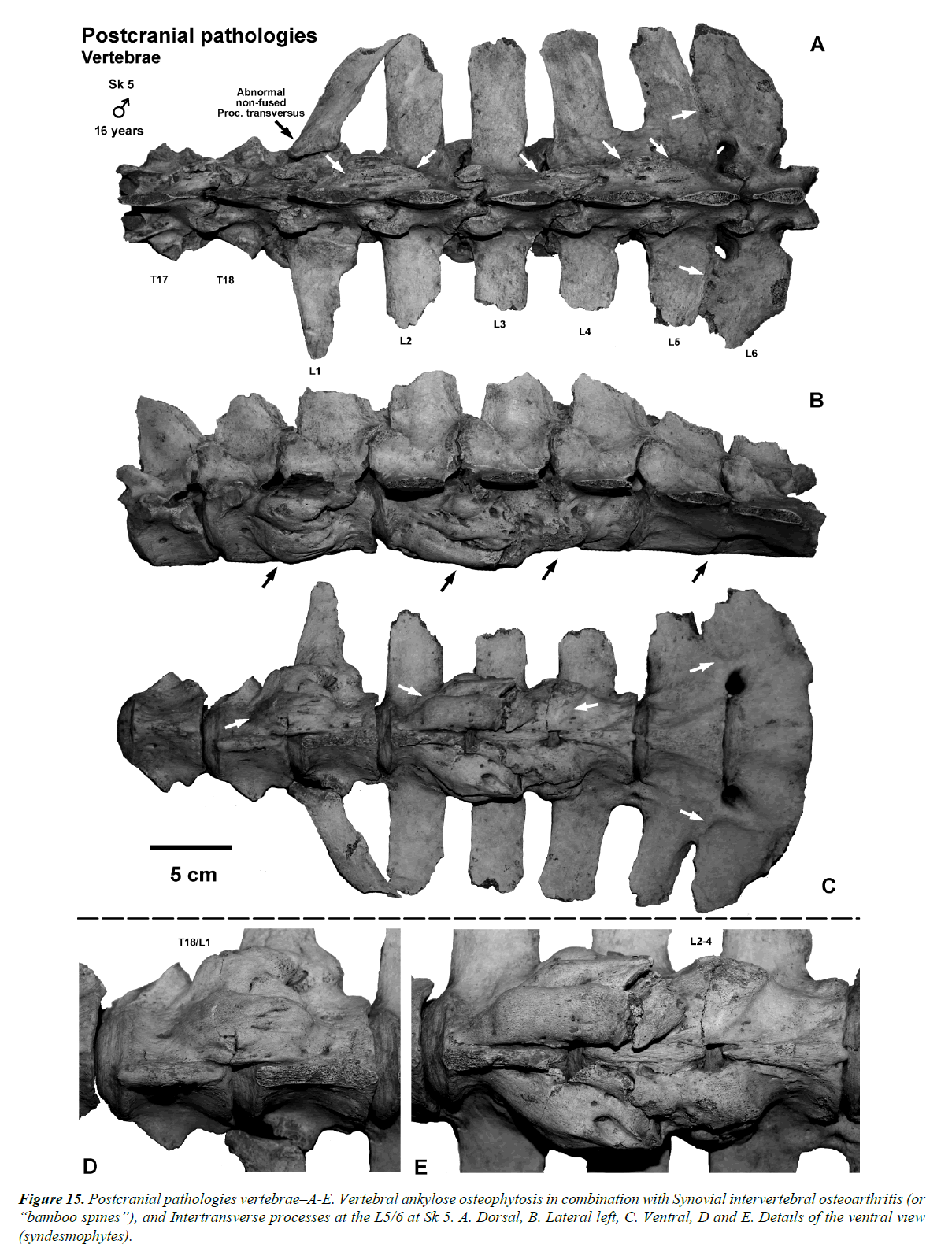 pathology-disease-biology-ankylose-osteophytosis