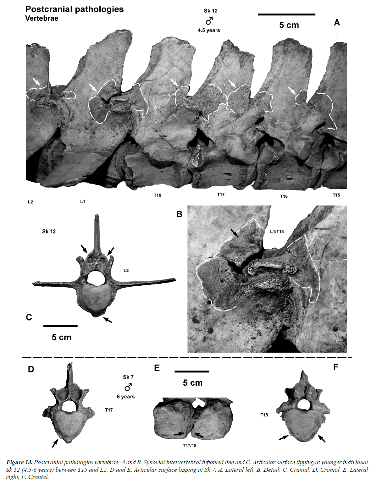 pathology-disease-biology-pathologies-vertebrae