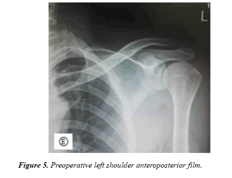 physical-therapy-sports-medicine-Preoperative-left-shoulder