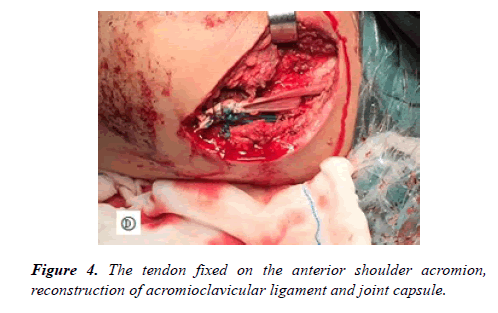 physical-therapy-sports-medicine-acromion-reconstruction