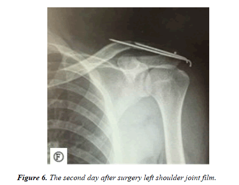 physical-therapy-sports-medicine-shoulder-joint