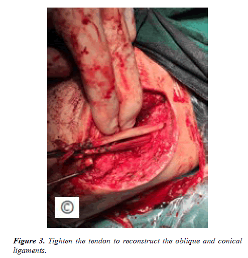 physical-therapy-sports-medicine-tendon-reconstruct