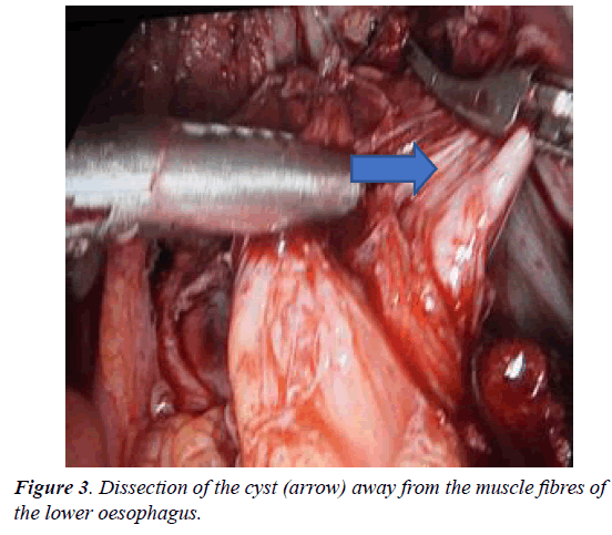 surgery-invasive-procedures-Dissection