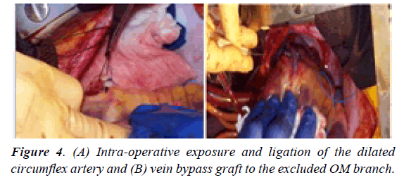 surgery-invasive-procedures-dilated-coronary-sinus