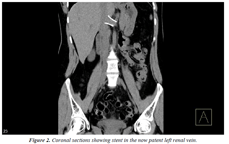 surgery-invasive-procedures-renal-vein