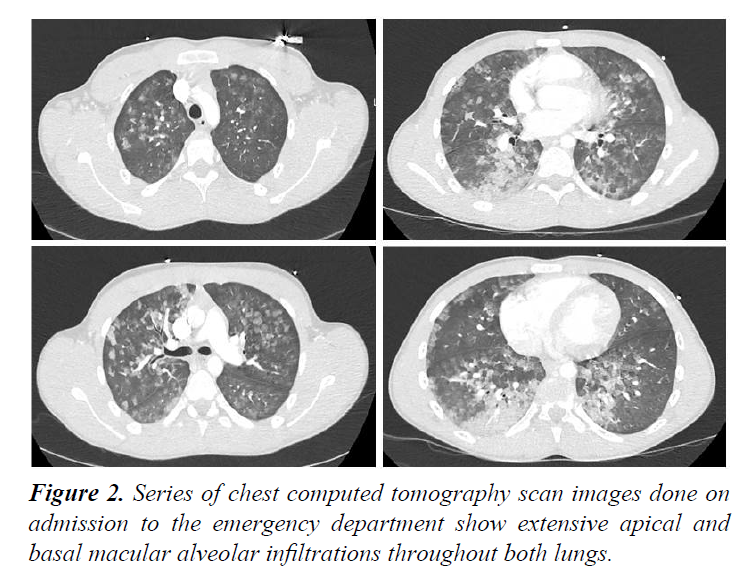 trauma-critical-care-alveolar-infiltrations