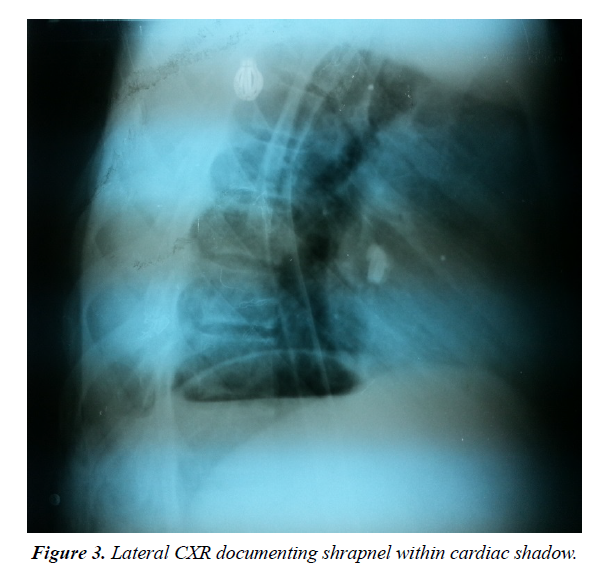 trauma-critical-care-cardiac-shadow