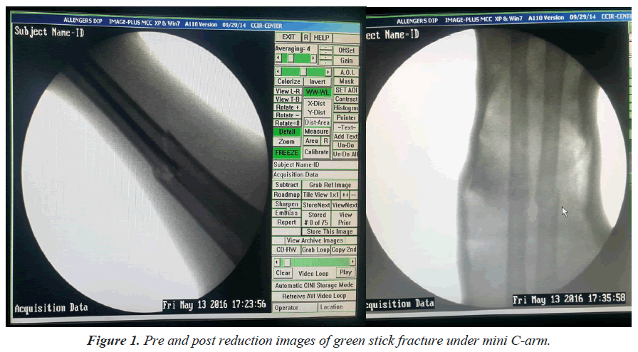 trauma-critical-care-green-stick-fracture