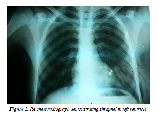 trauma-critical-care-left-ventricle