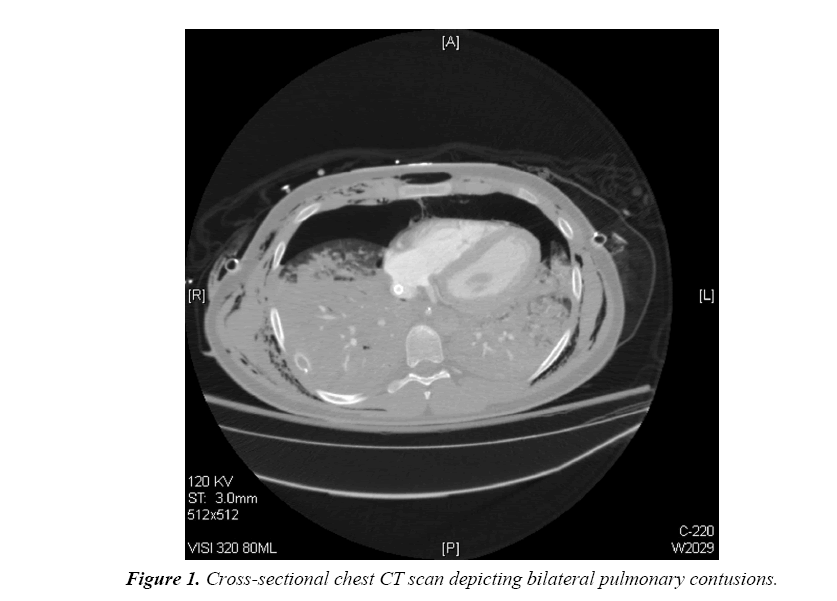 trauma-critical-care-pulmonary-contusions