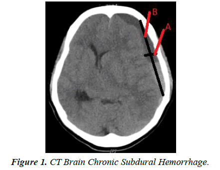 trauma-critical-care-subdural-hemorrhage