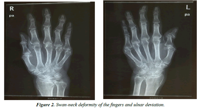 virology-research-ulnar-deviation